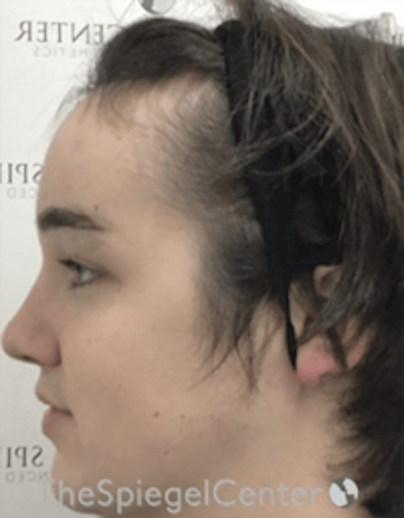 Hair Restoration Before & After Gallery - Patient 355913 - Image 1