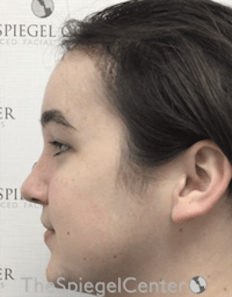 Hair Restoration Before & After Gallery - Patient 355913 - Image 2