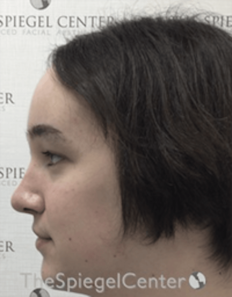 Hair Restoration Before & After Gallery - Patient 355913 - Image 4