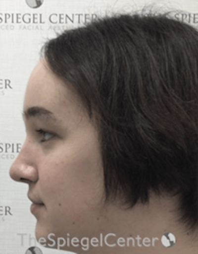 Hair Restoration Before & After Gallery - Patient 355913 - Image 4