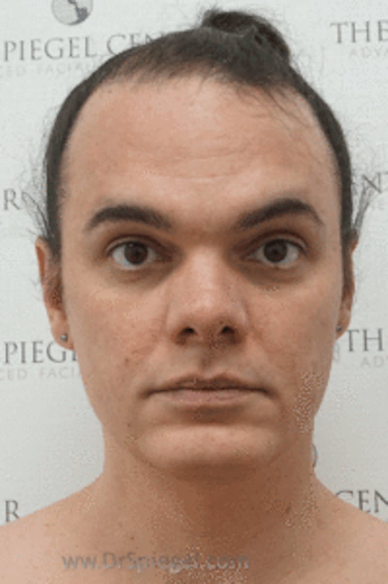 Hair Restoration Before & After Gallery - Patient 246257 - Image 1