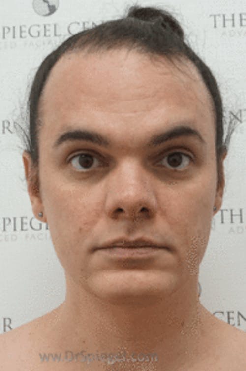 Hair Restoration Before & After Gallery - Patient 246257 - Image 1