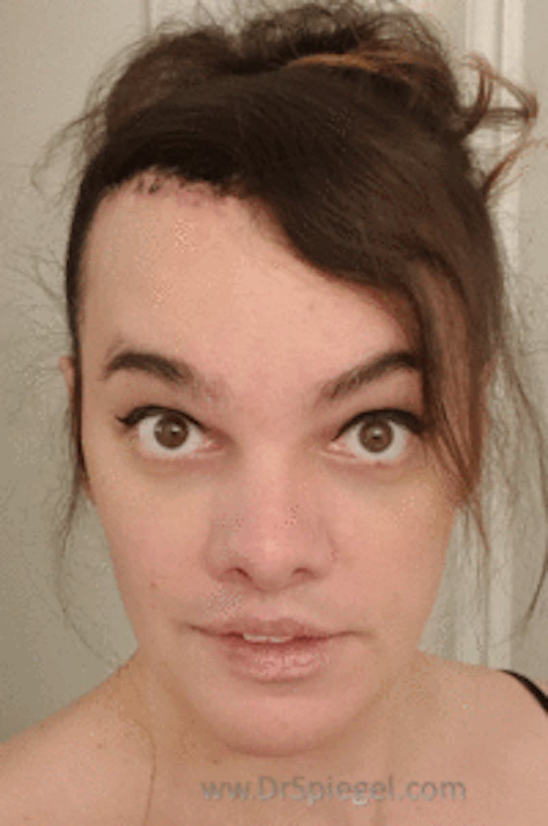 Hair Restoration Before & After Gallery - Patient 246257 - Image 2