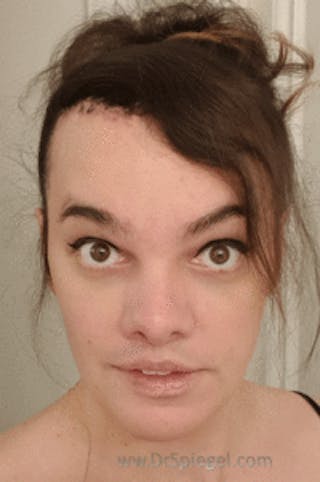 Hair Restoration Before & After Gallery - Patient 246257 - Image 2