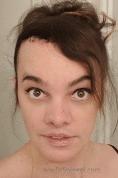 Hair Restoration Before & After Gallery - Patient 246257 - Image 2