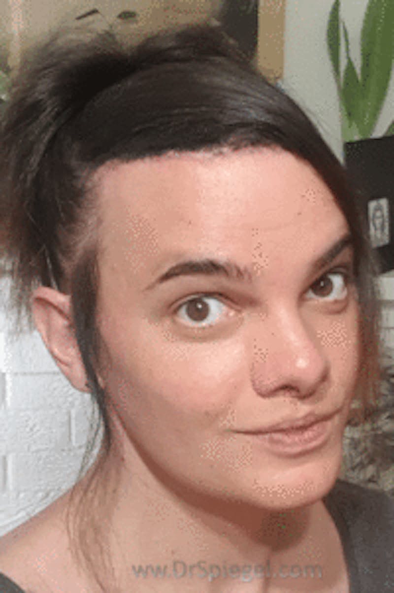 Hair Restoration Before & After Gallery - Patient 246257 - Image 4