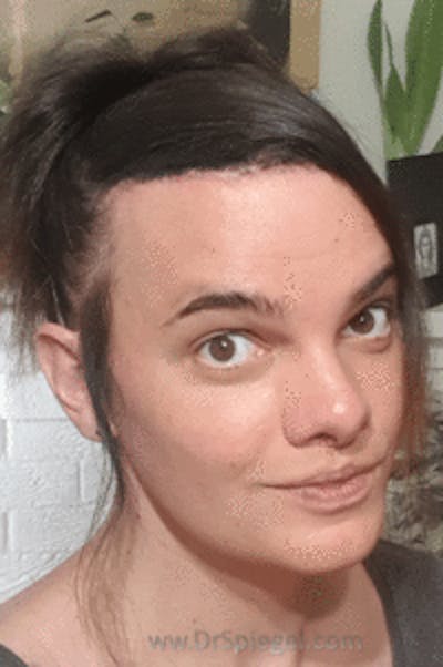 Hair Restoration Before & After Gallery - Patient 246257 - Image 4