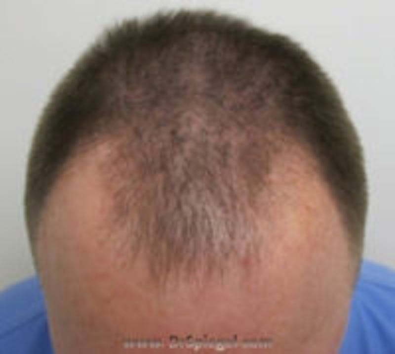 Hair Restoration Before & After Gallery - Patient 335527 - Image 1