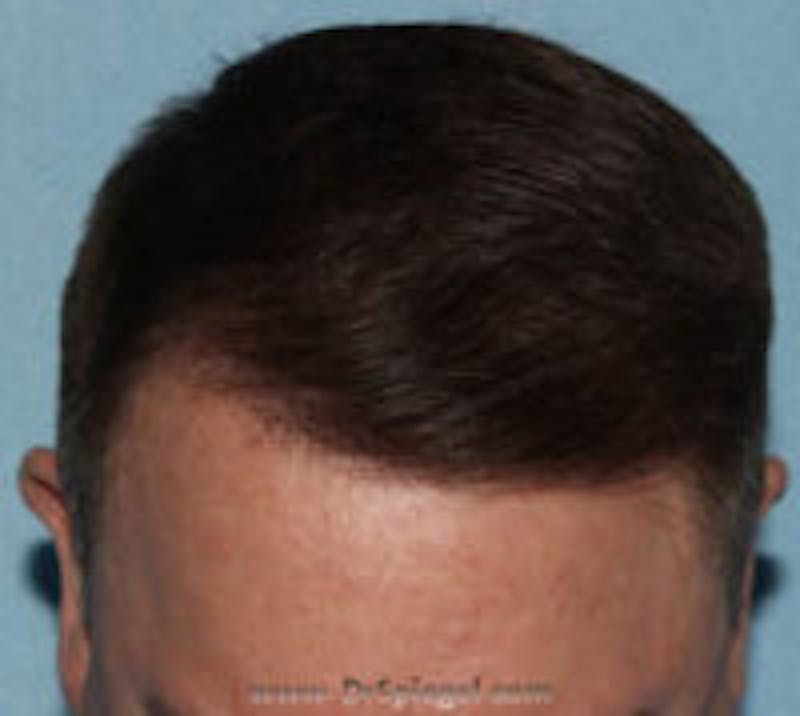 Hair Restoration Before & After Gallery - Patient 335527 - Image 2