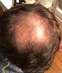Hair Restoration Before & After Gallery - Patient 316402 - Image 1