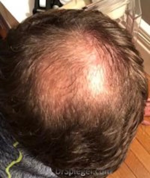 Hair Restoration Before & After Gallery - Patient 316402 - Image 1