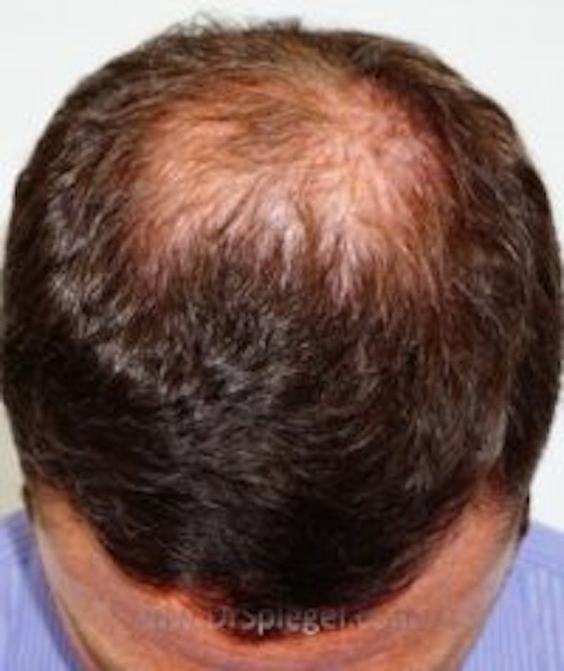 Hair Restoration Before & After Gallery - Patient 316402 - Image 2