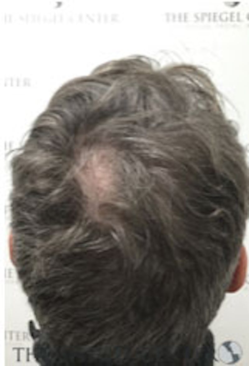 Hair Restoration Before & After Gallery - Patient 424762 - Image 1