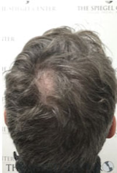 Hair Restoration Before & After Gallery - Patient 424762 - Image 1