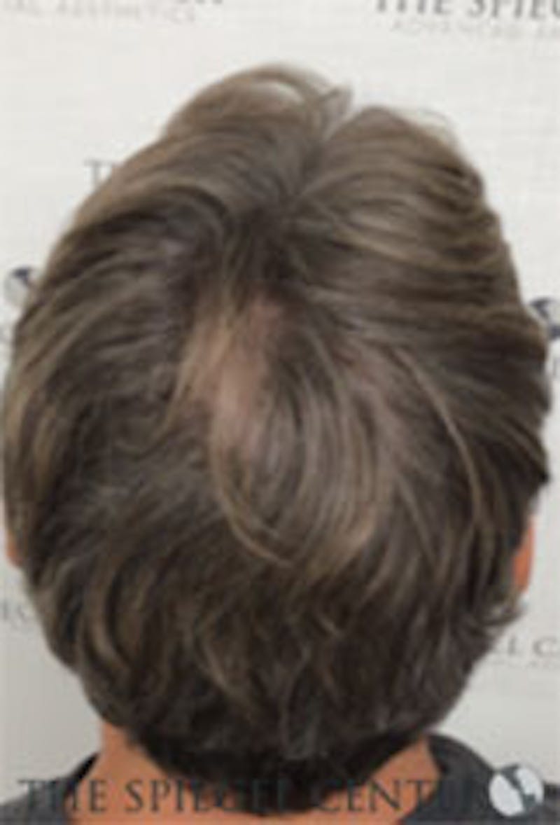 Hair Restoration Before & After Gallery - Patient 424762 - Image 2