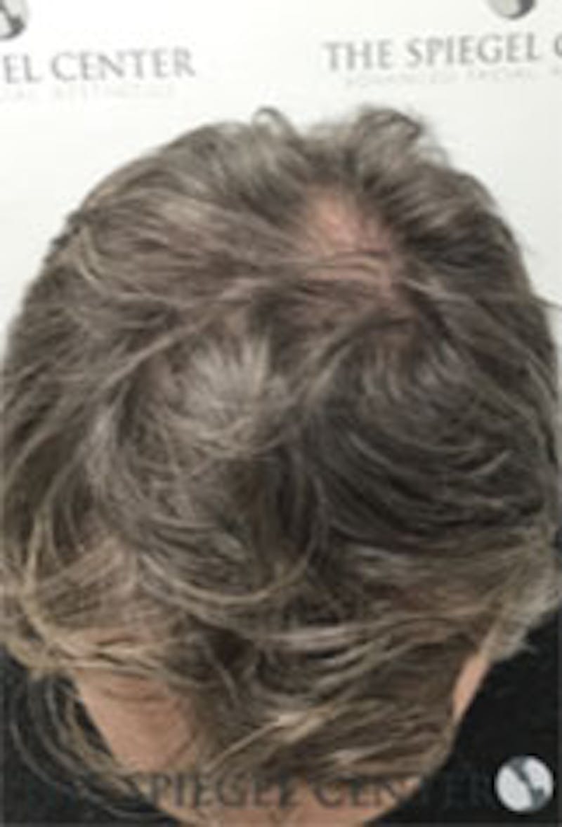Hair Restoration Before & After Gallery - Patient 424762 - Image 3