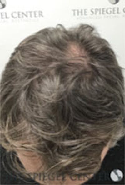 Hair Restoration Before & After Gallery - Patient 424762 - Image 3