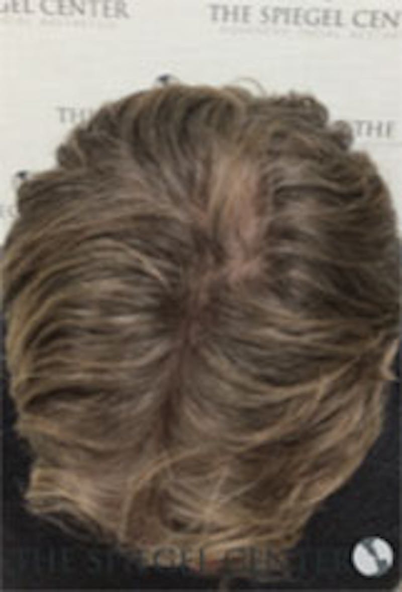 Hair Restoration Before & After Gallery - Patient 424762 - Image 4