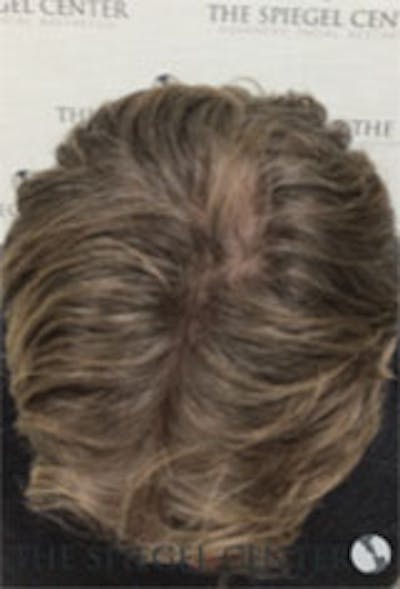 Hair Restoration Before & After Gallery - Patient 424762 - Image 4
