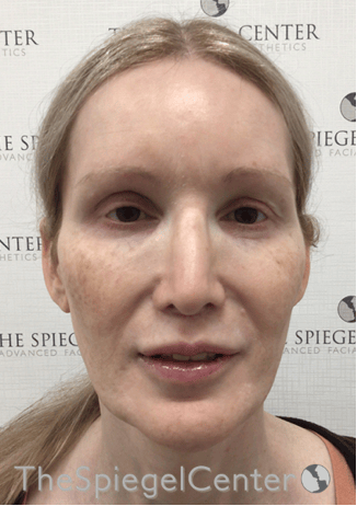 Hair Restoration Before & After Gallery - Patient 669699 - Image 2