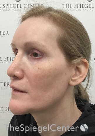 Hair Restoration Before & After Gallery - Patient 669699 - Image 3