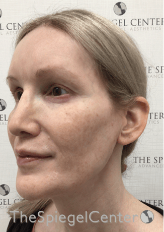 Hair Restoration Before & After Gallery - Patient 669699 - Image 4