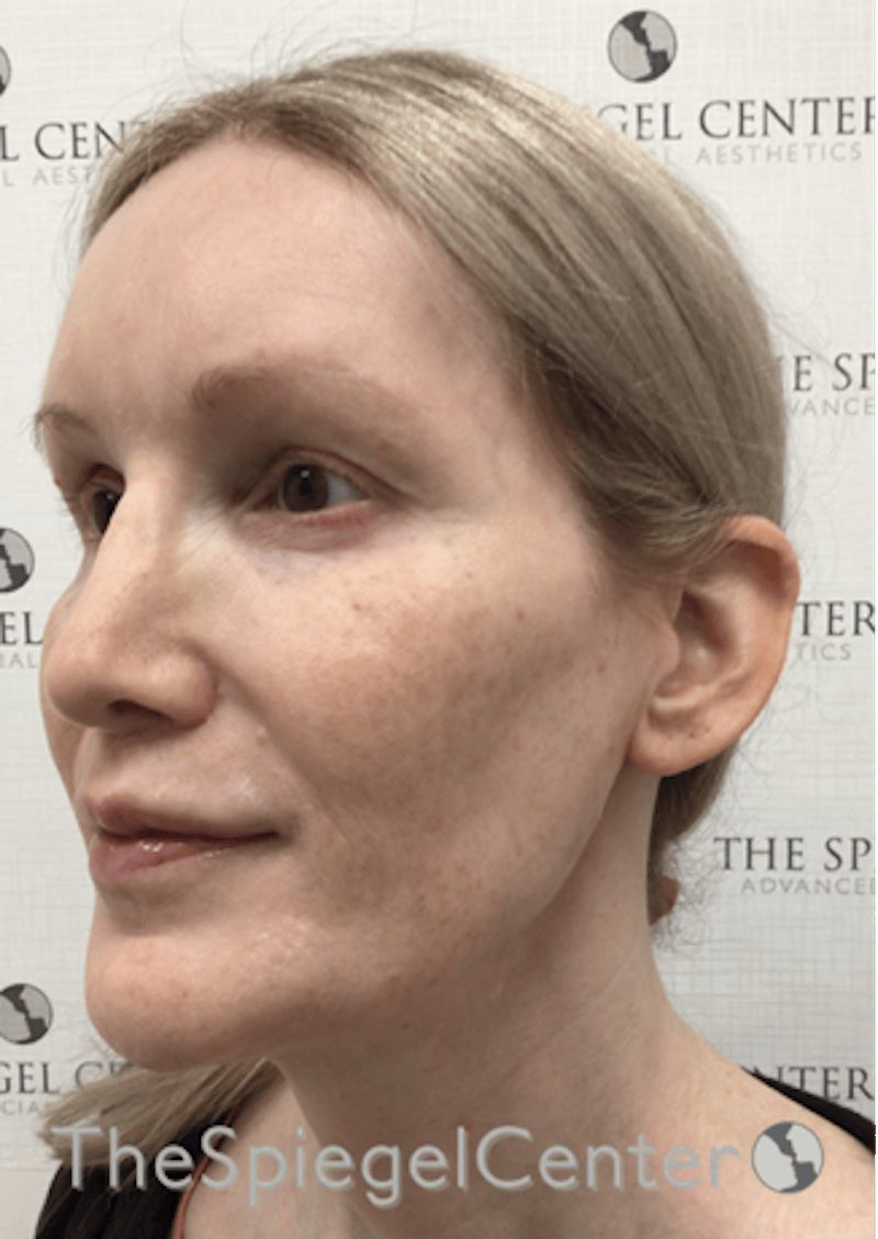 Hair Restoration Before & After Gallery - Patient 669699 - Image 4