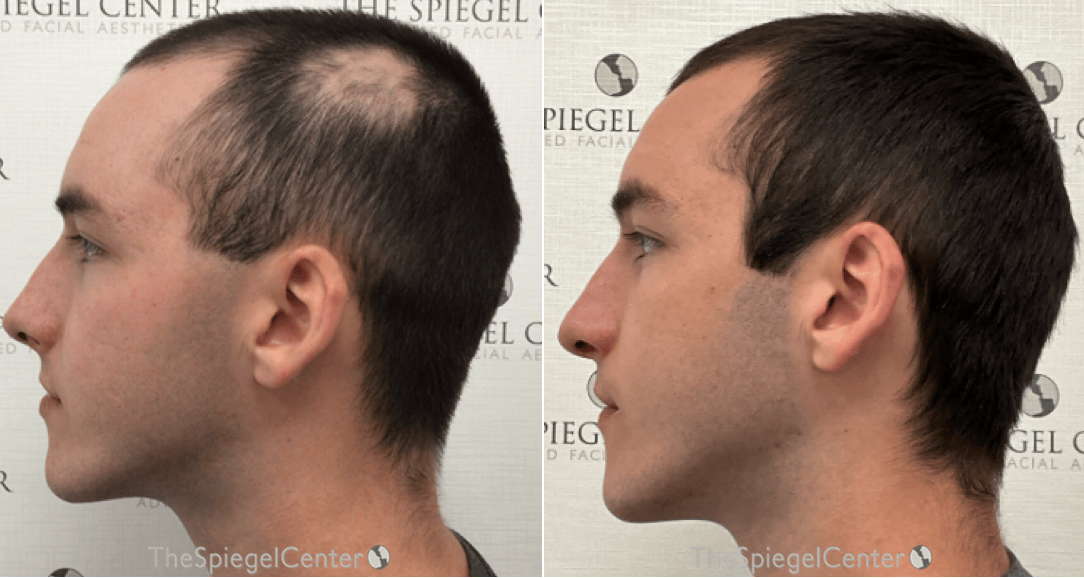 Hair Restoration Before & After Gallery - Patient 312431 - Image 1