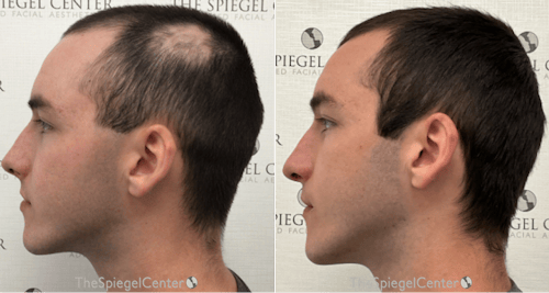 Hair Restoration Before & After Gallery - Patient 312431 - Image 1