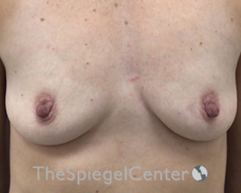 Breast Augmentation Before & After Gallery - Patient 255626 - Image 1