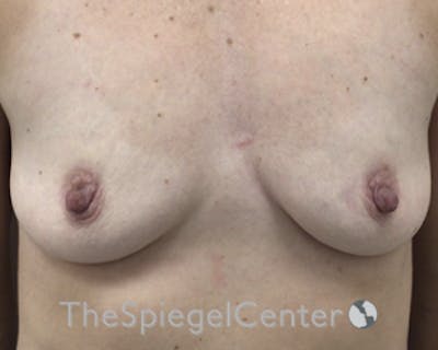Breast Augmentation Before & After Gallery - Patient 255626 - Image 1