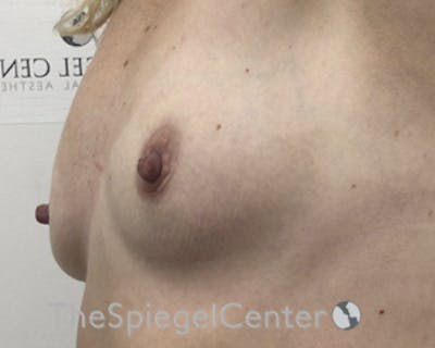 Breast Augmentation Before & After Gallery - Patient 255626 - Image 3