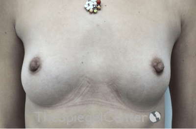 Breast Augmentation Before & After Gallery - Patient 388275 - Image 1