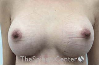Breast Augmentation Before & After Gallery - Patient 388275 - Image 2
