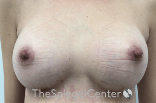 Breast Augmentation Before & After Gallery - Patient 388275 - Image 2