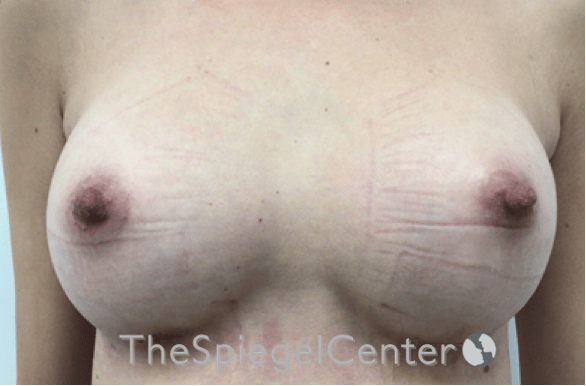 Breast Augmentation Before & After Gallery - Patient 388275 - Image 2