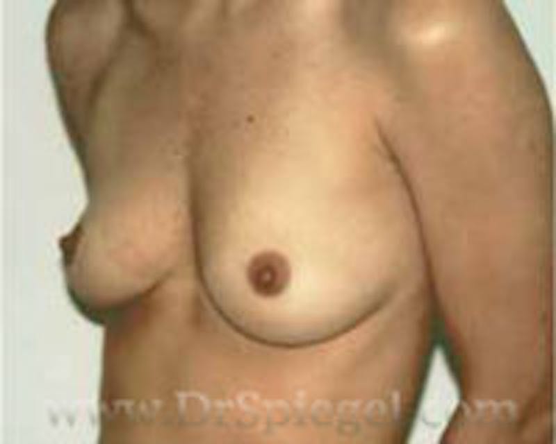 Breast Augmentation Before & After Gallery - Patient 103516 - Image 1