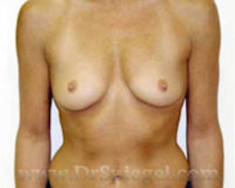 Breast Augmentation Before & After Gallery - Patient 214084 - Image 1