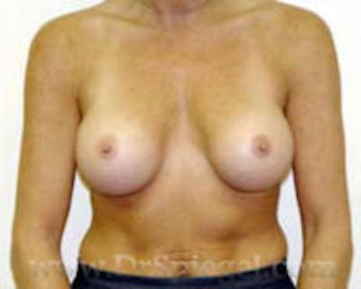 Breast Augmentation Before & After Gallery - Patient 214084 - Image 2