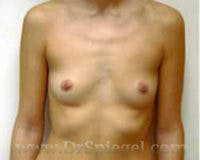 Breast Augmentation Before & After Gallery - Patient 317442 - Image 1