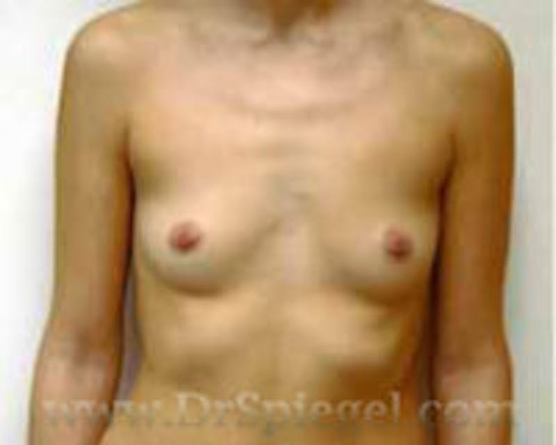 Breast Augmentation Before & After Gallery - Patient 317442 - Image 1