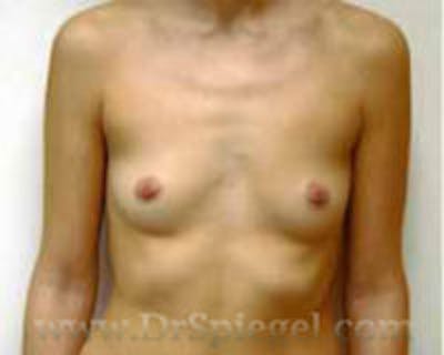 Breast Augmentation Before & After Gallery - Patient 317442 - Image 1