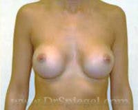 Breast Augmentation Before & After Gallery - Patient 317442 - Image 2