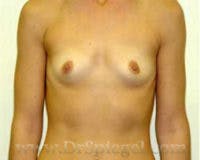 Breast Augmentation Before & After Gallery - Patient 344209 - Image 1
