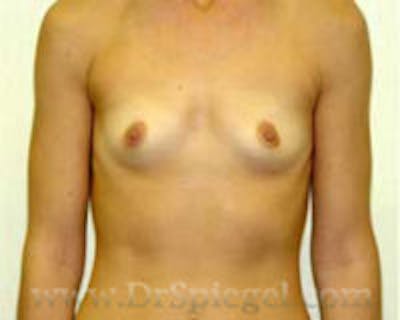 Breast Augmentation Before & After Gallery - Patient 344209 - Image 1