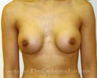 Breast Augmentation Before & After Gallery - Patient 111417 - Image 2