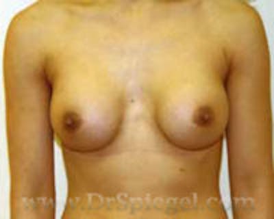 Breast Augmentation Before & After Gallery - Patient 111417 - Image 2