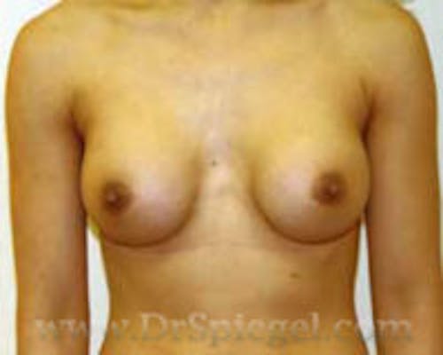 Breast Augmentation Before & After Gallery - Patient 111417 - Image 2