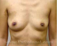 Breast Augmentation Before & After Gallery - Patient 351759 - Image 1