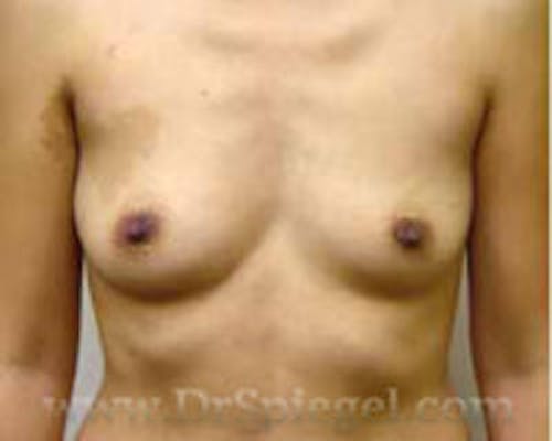 Breast Augmentation Before & After Gallery - Patient 351759 - Image 1